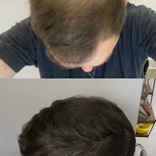 Gofybr 7g free sample — customer hair thickening before and after